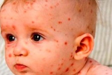 95 درصد از کودکان ایلامی واکسن MMR دریافت کرده‌اند