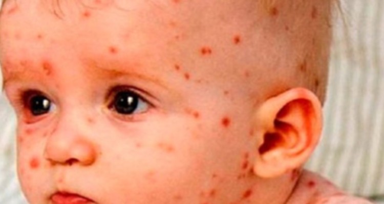 95 درصد از کودکان ایلامی واکسن MMR دریافت کرده‌اند