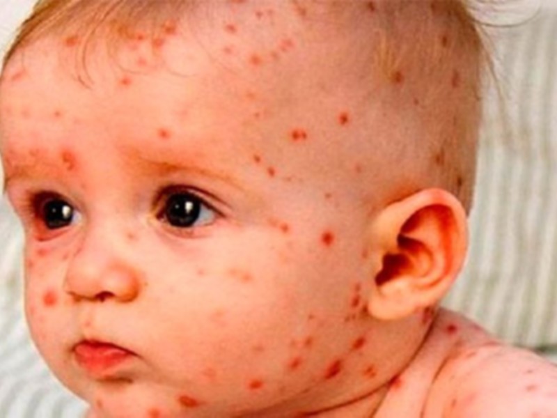 95 درصد از کودکان ایلامی واکسن MMR دریافت کردهاند 95 درصد از کودکان ایلامی واکسن MMR دریافت کردهاند